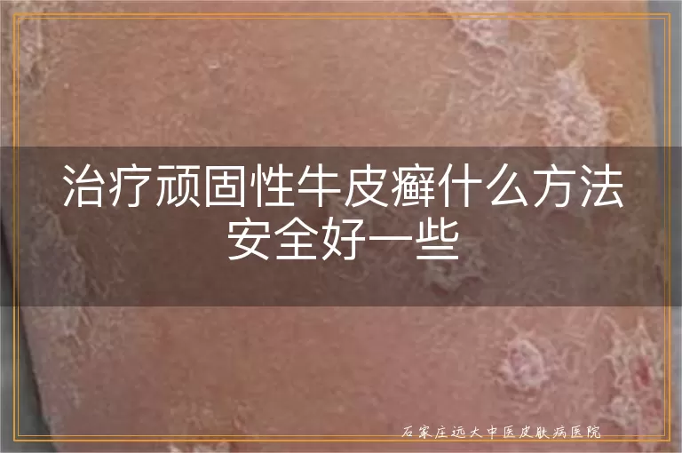 治疗顽固性牛皮癣什么方法安全好一些