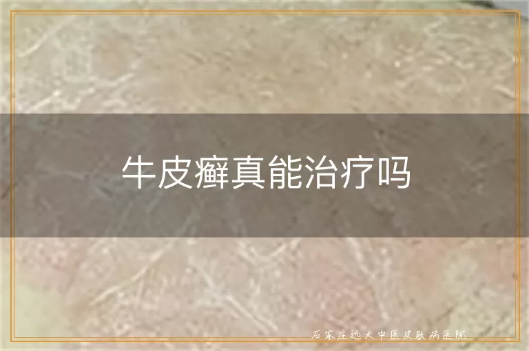 牛皮癣真能治疗吗