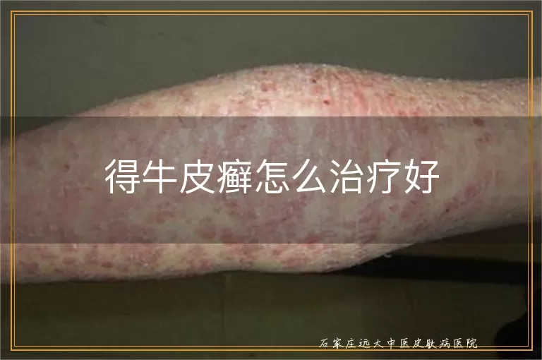 得牛皮癣怎么治疗好