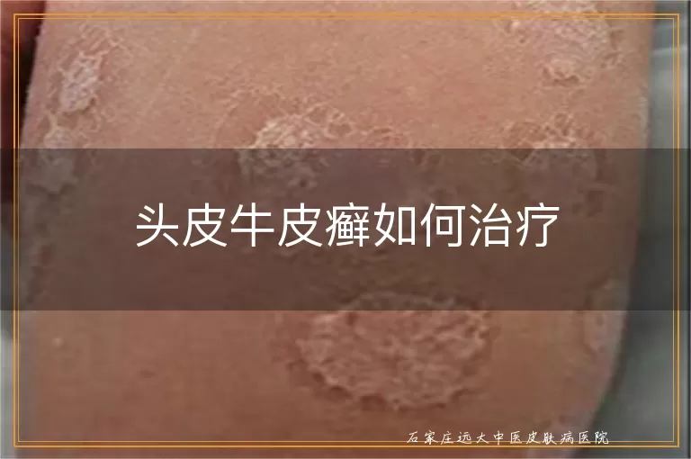 头皮牛皮癣如何治疗