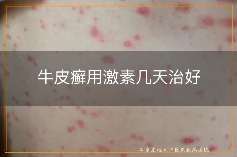 牛皮癣用激素几天治好