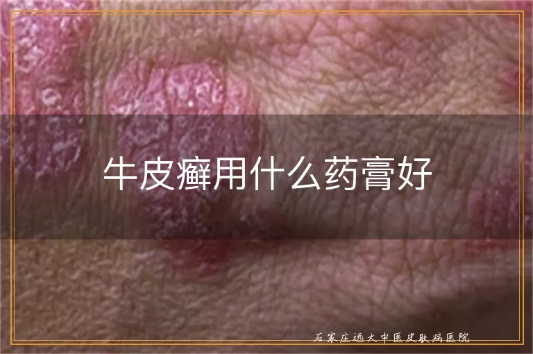 牛皮癣用什么药膏好