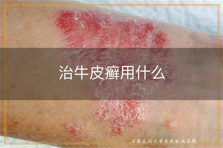 治牛皮癣用什么