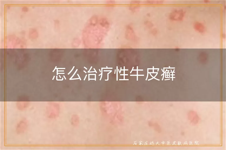 怎么治疗性牛皮癣
