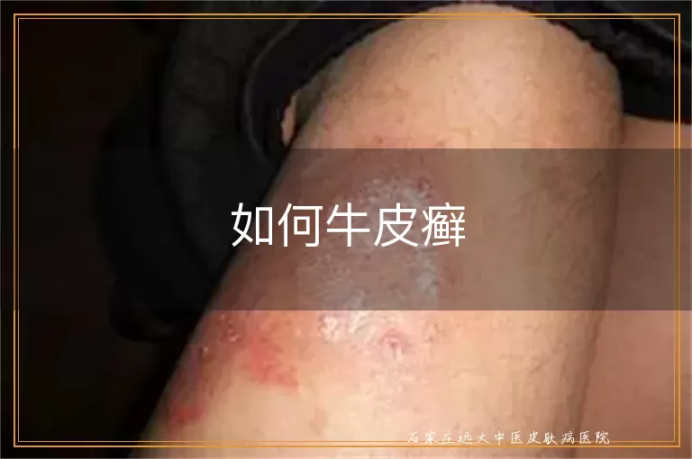 如何牛皮癣