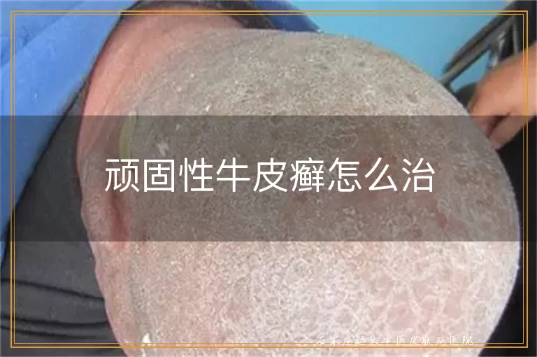 顽固性牛皮癣怎么治