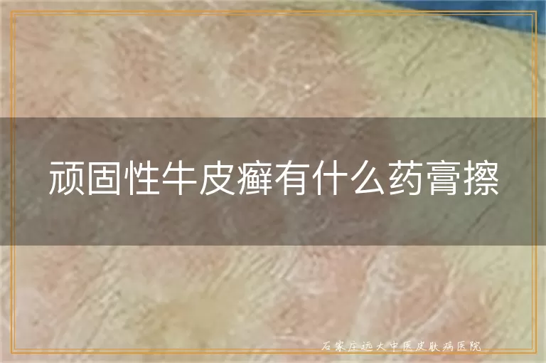 顽固性牛皮癣有什么药膏擦
