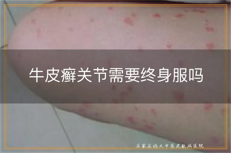 牛皮癣关节需要终身服吗