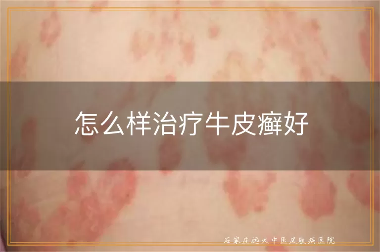 怎么样治疗牛皮癣好