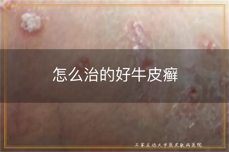 怎么治的好牛皮癣