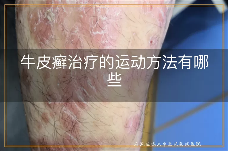 牛皮癣治疗的运动方法有哪些