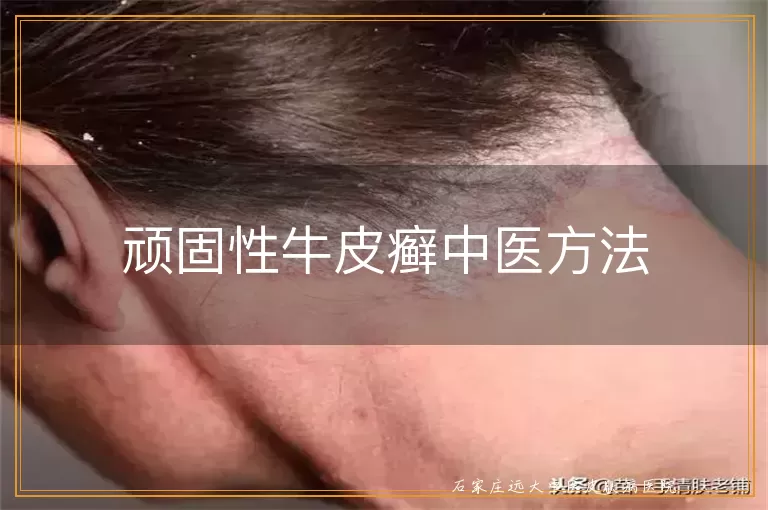 顽固性牛皮癣中医方法