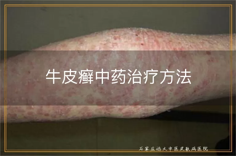 牛皮癣中药治疗方法
