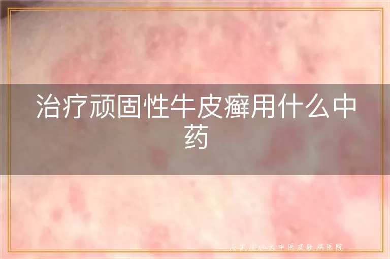 治疗顽固性牛皮癣用什么中药