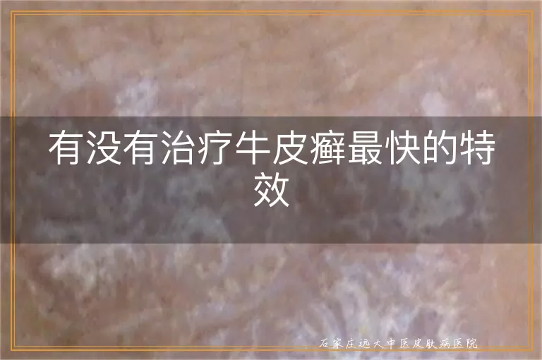 有没有治疗牛皮癣最快的特效