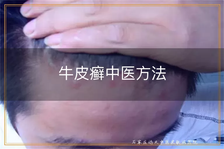 牛皮癣中医方法