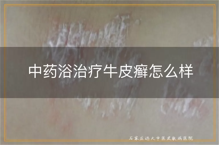 中药浴治疗牛皮癣怎么样