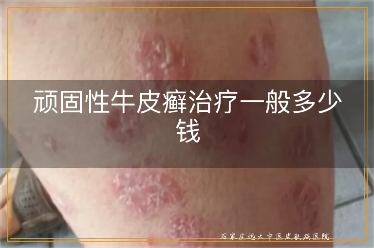 顽固性牛皮癣治疗一般多少钱