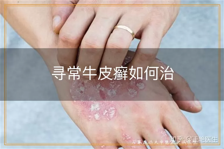 寻常牛皮癣如何治