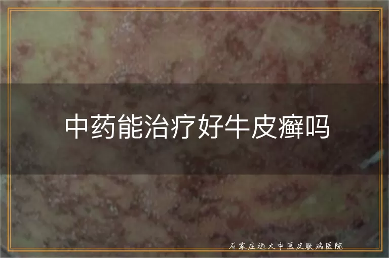 中药能治疗好牛皮癣吗