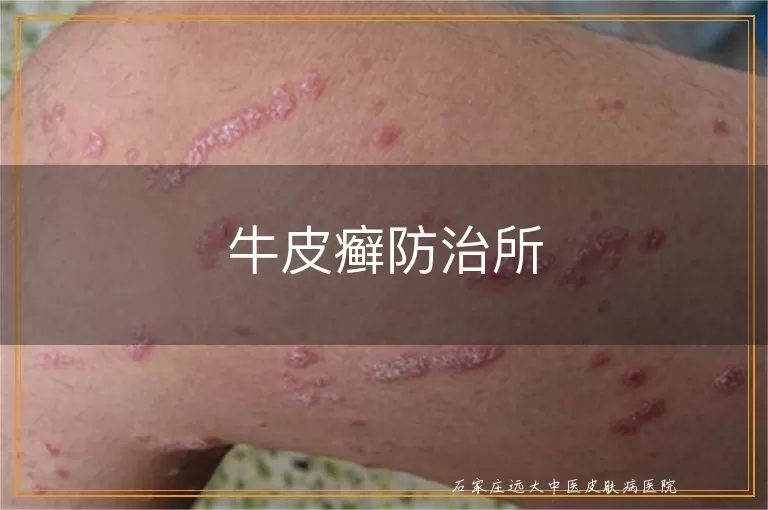 牛皮癣防治所
