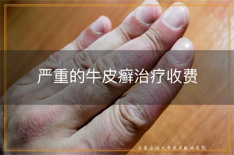 严重的牛皮癣治疗收费