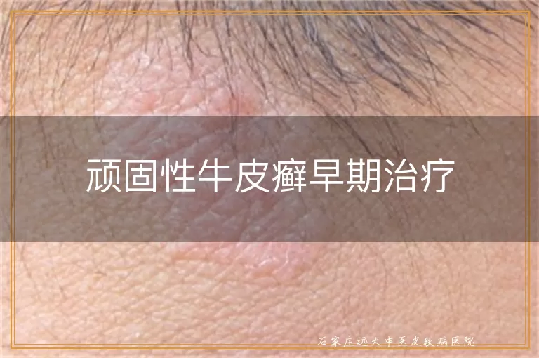 顽固性牛皮癣早期治疗