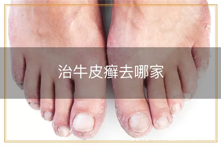治牛皮癣去哪家