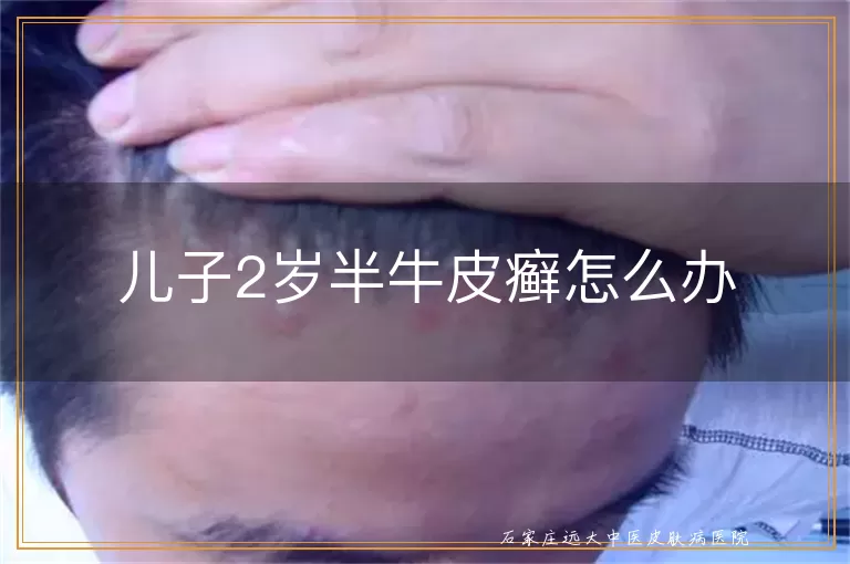 儿子2岁半牛皮癣怎么办