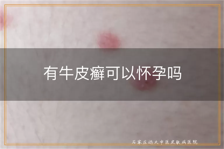 有牛皮癣可以怀孕吗