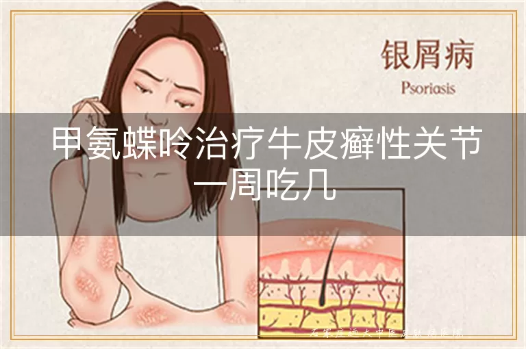 甲氨蝶呤治疗牛皮癣性关节一周吃几