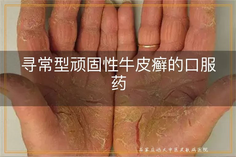 寻常型顽固性牛皮癣的口服药