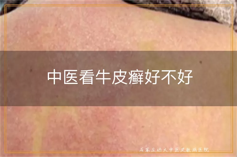 中医看牛皮癣好不好
