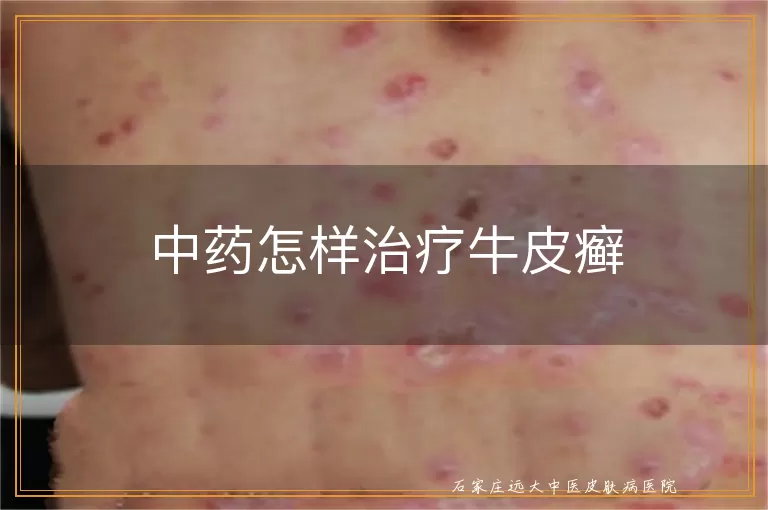 中药怎样治疗牛皮癣