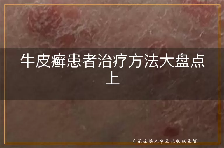 牛皮癣患者治疗方法大盘点上