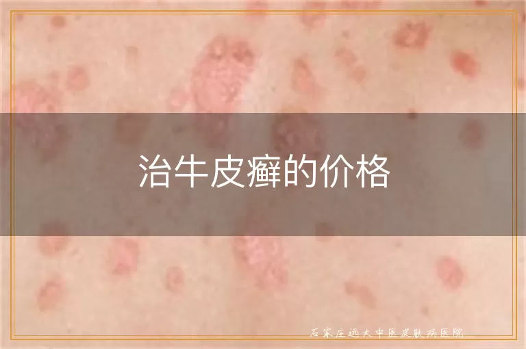 治牛皮癣的价格