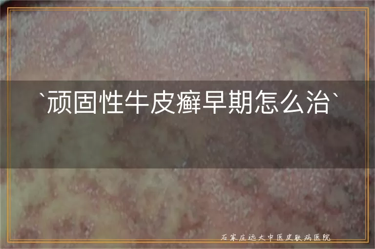 顽固性牛皮癣早期怎么治
