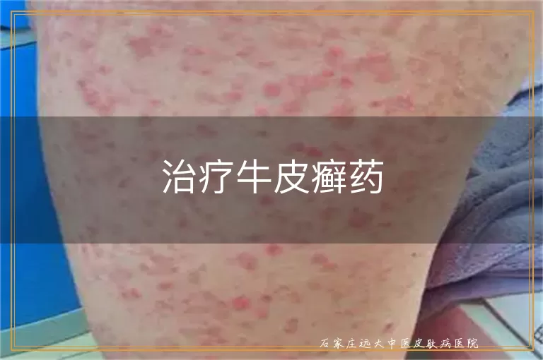 治疗牛皮癣药