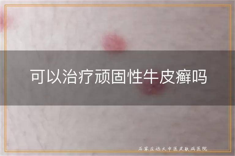 可以治疗顽固性牛皮癣吗