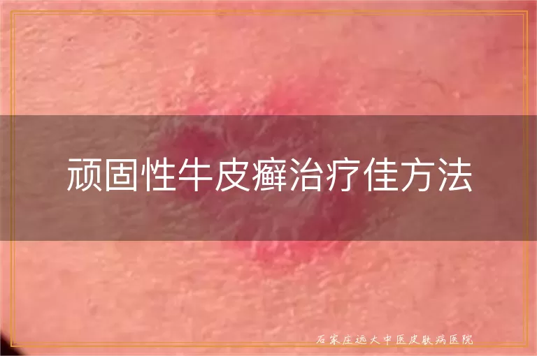 顽固性牛皮癣治疗佳方法