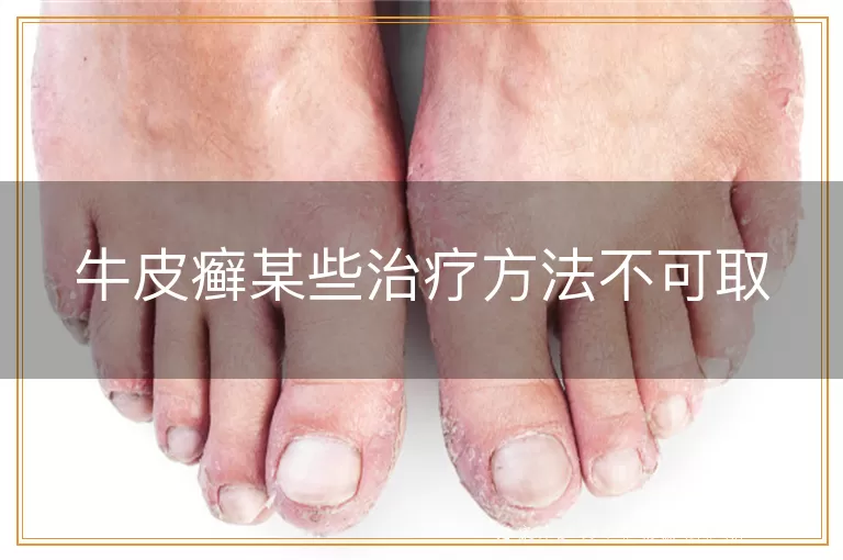 牛皮癣某些治疗方法不可取