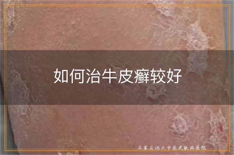 如何治牛皮癣较好