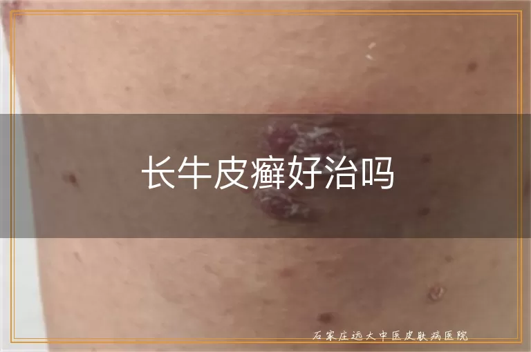长牛皮癣好治吗