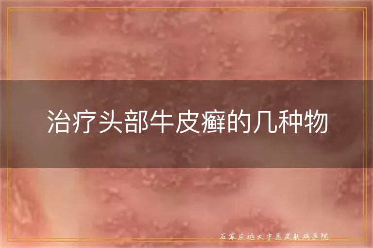 治疗头部牛皮癣的几种物