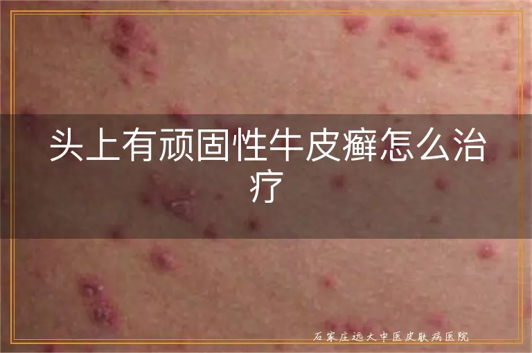 头上有顽固性牛皮癣怎么治疗