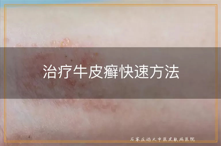 治疗牛皮癣快速方法