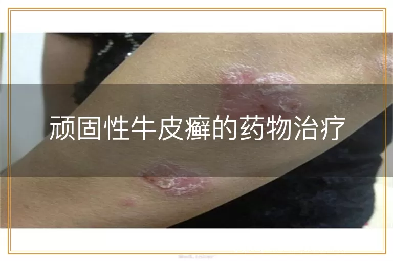 顽固性牛皮癣的药物治疗