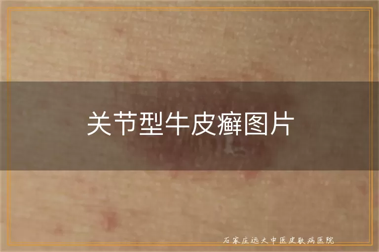 关节型牛皮癣图片