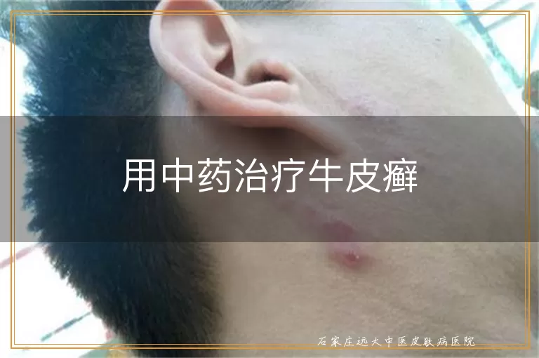 用中药治疗牛皮癣