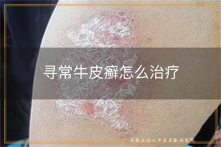 寻常牛皮癣怎么治疗